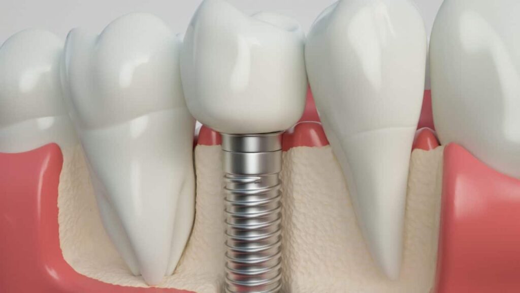 Implants dentaires remplacer dents