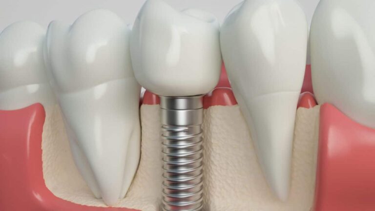 Implants dentaires remplacer dents