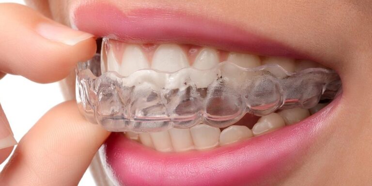 Invisalign 1920x600 1 1200x600 1