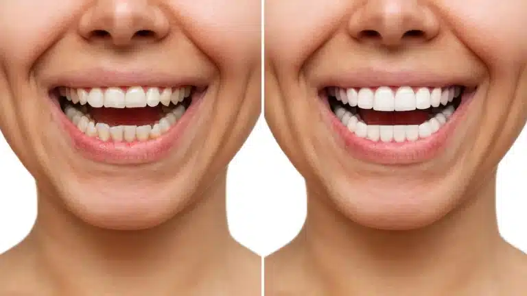 Blanchiment dentaire : Techniques modernes et efficacité comparée 13 blanchiment dentaire 1