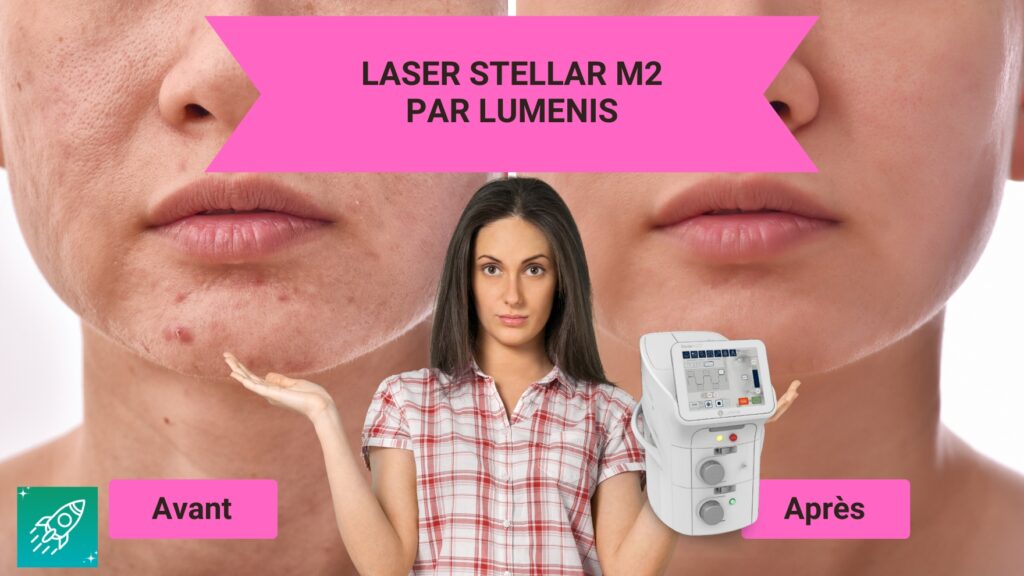 laser stellar m2 lumenis